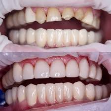 Caring for dental implants